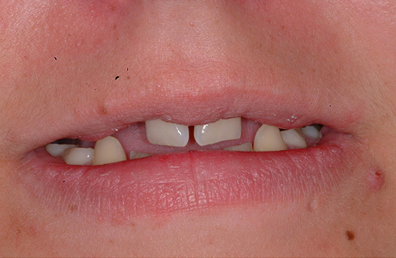before treatment at Pristine Dental