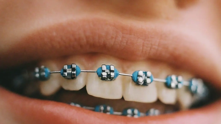 Transforming Smiles at Any Age: Success Stories in Adult Orthodontics