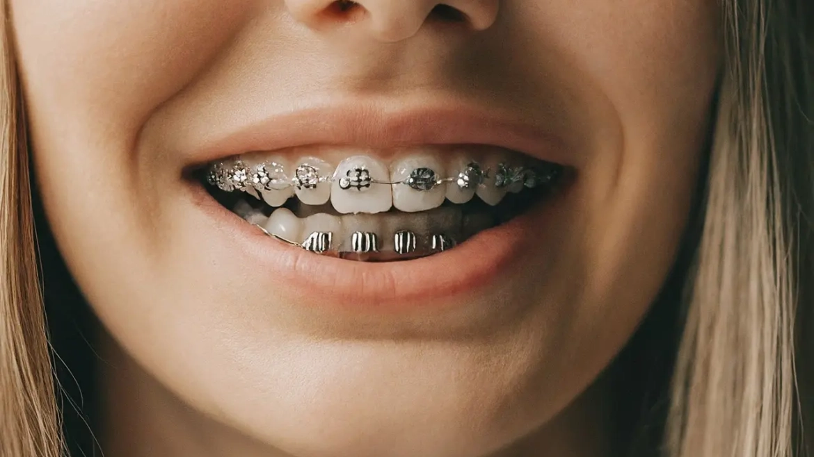 10 Benefits of Choosing Adult Orthodontics for a Healthier Smile