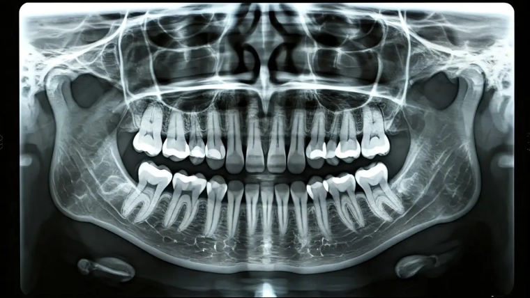 ¿Qué es una radiografía dental y por qué es necesaria?