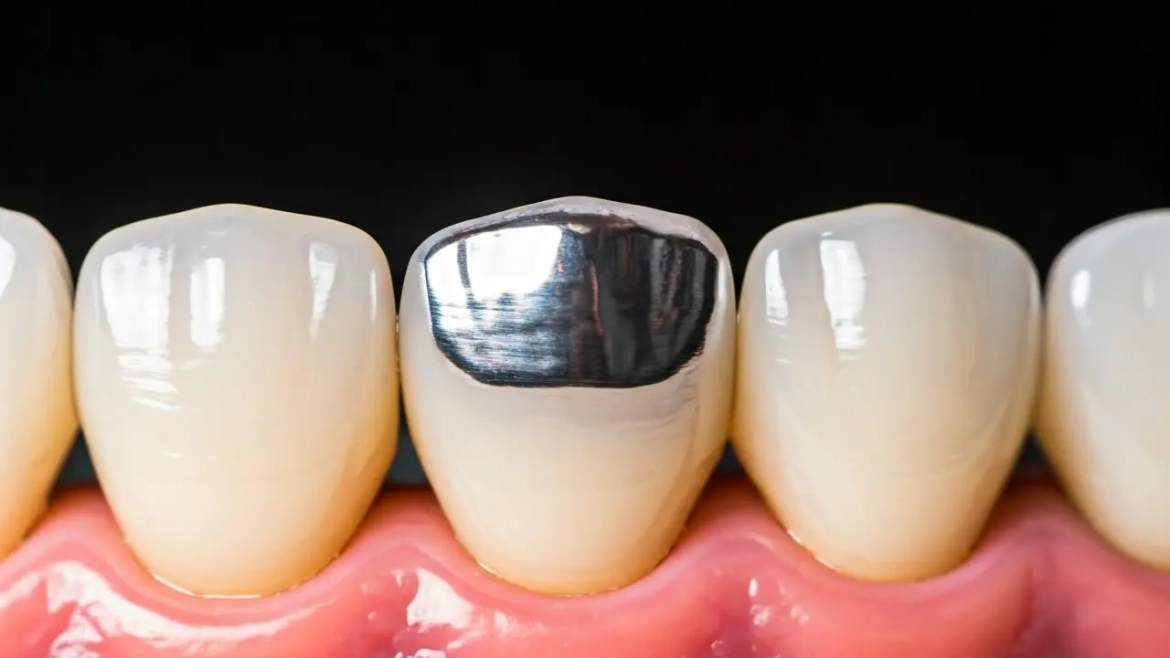 12 Facts About Dental Crown Repair You Didn’t Know