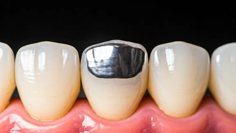 12 Facts About Dental Crown Repair You Didn’t Know