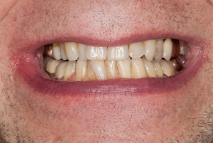 discolored teeth