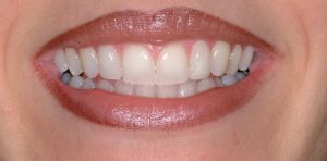 after treatment at Pristine Dental