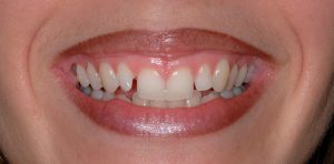 before treatment at Pristine Dental
