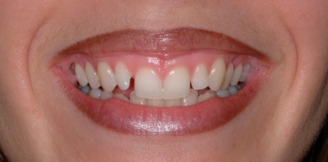 before treatment at Pristine Dental