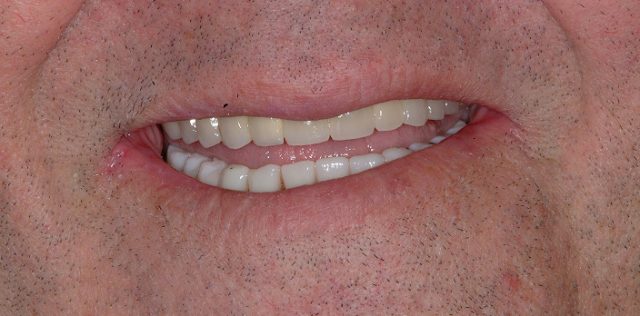 treatment at Pristine Dental