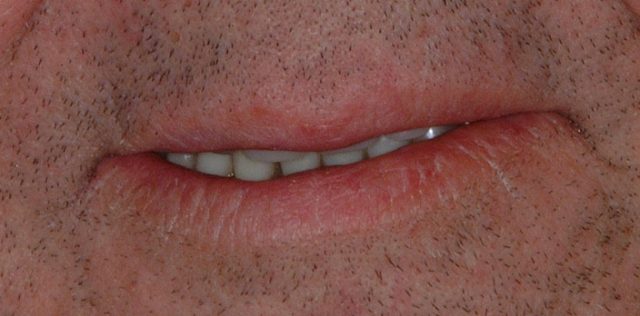 treatment at Pristine Dental