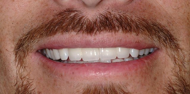 After treatment at Pristine Dental