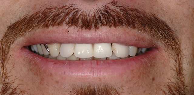 before treatment at Pristine Dental
