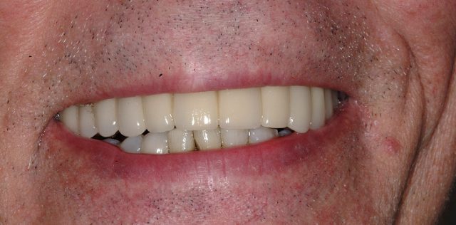 after treatment at Pristine Dental