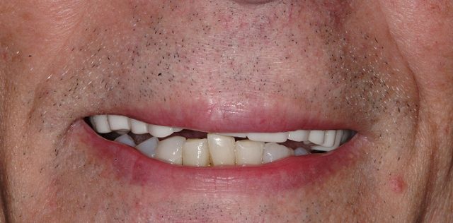 before treatment at Pristine Dental