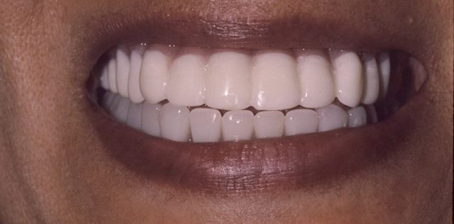 after treatment at Pristine Dental