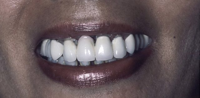 before treatment at Pristine Dental
