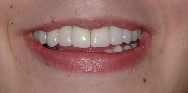 after treatment at Pristine Dental