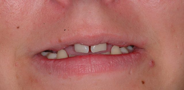 before treatment at Pristine Dental