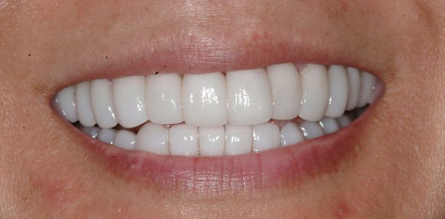 after treatment at Pristine Dental