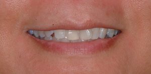 before treatment at Pristine Dental