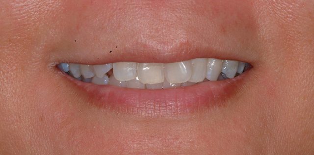 before treatment at Pristine Dental
