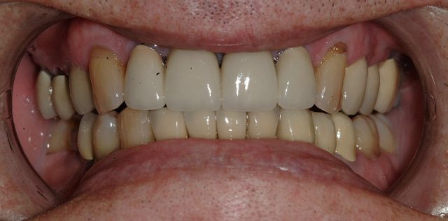 treatment at Pristine Dental