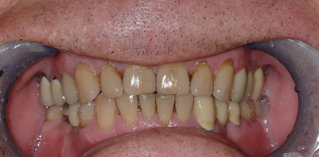 before treatment at Pristine Dental