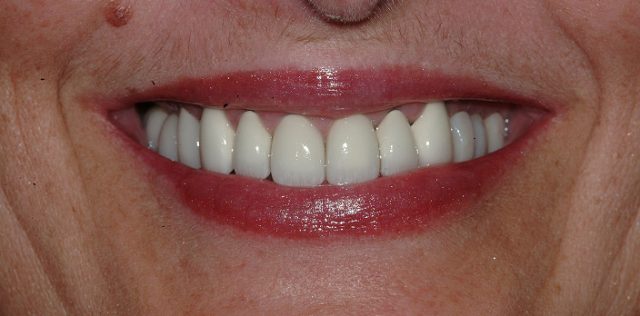 after treatment at Pristine Dental