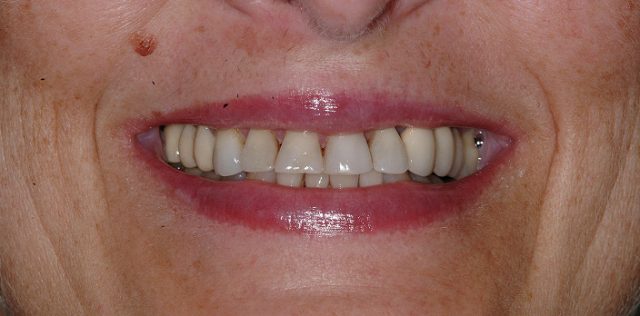 before treatment at Pristine Dental
