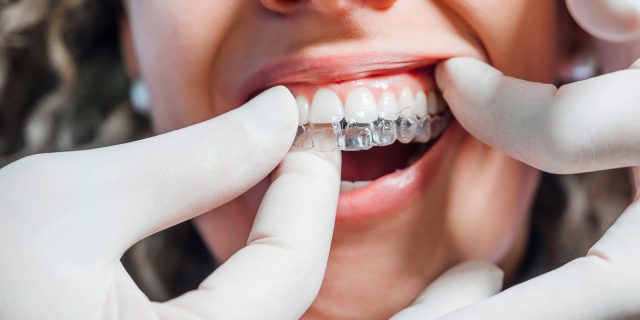 clear aligners near you