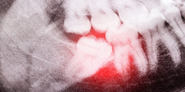 impacted wisdom tooth on x-rays