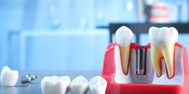 dental implants near you