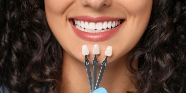 porcelain veneers shades