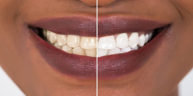 before and after teeth whitening in Scottsdale