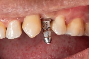 narrow diameter dental implant