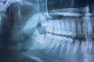 x-ray of impacted wisdom teeth