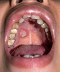 oral cancer symptoms, mouth sores