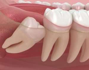 impacted wisdom tooth