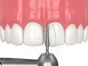 shaping dental bonding