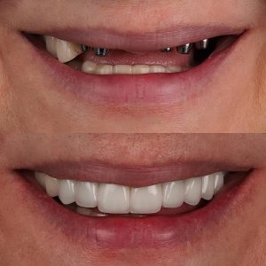 dental implants in mouth